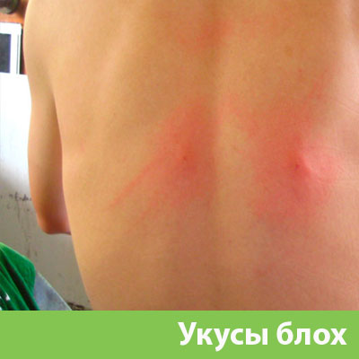 Укусы блох в Йошкар-Оле