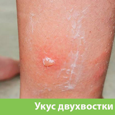 Укус двухвостки в Йошкар-Оле