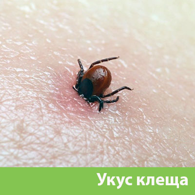 Укус клеща в Йошкар-Оле
