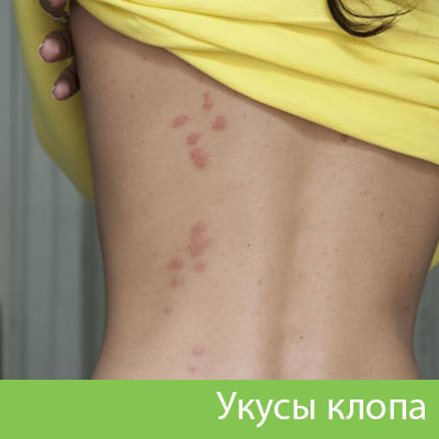 Профессиональное уничтожение клопов в Йошкар-Оле